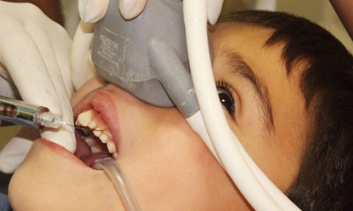 Nitrous Oxide Concious Sedation in Dentistry